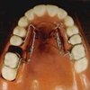 Distal Jet zur Rückbewegung oberer Seitenzähne ohne Headgear (Außenbogen)