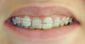 Keramikbrackets sind weniger auffällig als Stahlbrackets, aber nicht unsichtbar