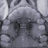 Pendex-Zahnspange zur Rückbewegung oberer Seitenzähne ohne Headgear und gleichzeitiger Verbreiterung des Oberkiefers