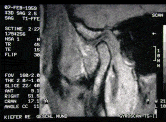 Magnetresonanztomogramm (MRT) des Kiefergelenks