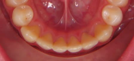 Nach der kieferorthop&auml;dischen Behandlung mit 14 Jahren: alles perfekt. Ein fester Retainer wurde empfohlen, war aber nicht erw&uuml;nscht