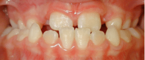 Zahnfehlstellung, Frontalansicht, einer jungen Patientin vor der Gaumennahterweiterung…
