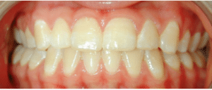 Zahnstellung, Frontansicht, nach 18 Monaten Behandlung mit GNE und Brackets (in zwei Phasen mit Pause)