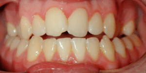 Zähne vor der Zahnkorrektur: Ein jugendlicher Patient vor der Gaumennahterweiterung…