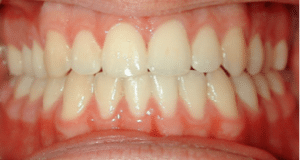 Zahnkorrektur, Foto frontal, nach GNE und Brackets, Behandlungsdauer 16 Monate