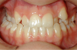 Zähne einer jungen Patientin vor der Gaumennahterweiterung…