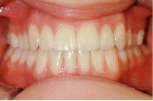 Korrigierte Zähne, frontal, nach GNE und Brackets, Behandlungsdauer nur 9 Monate