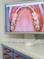 Intraorales Foto mit innen liegender Zahnspange (Lingualtechnik).