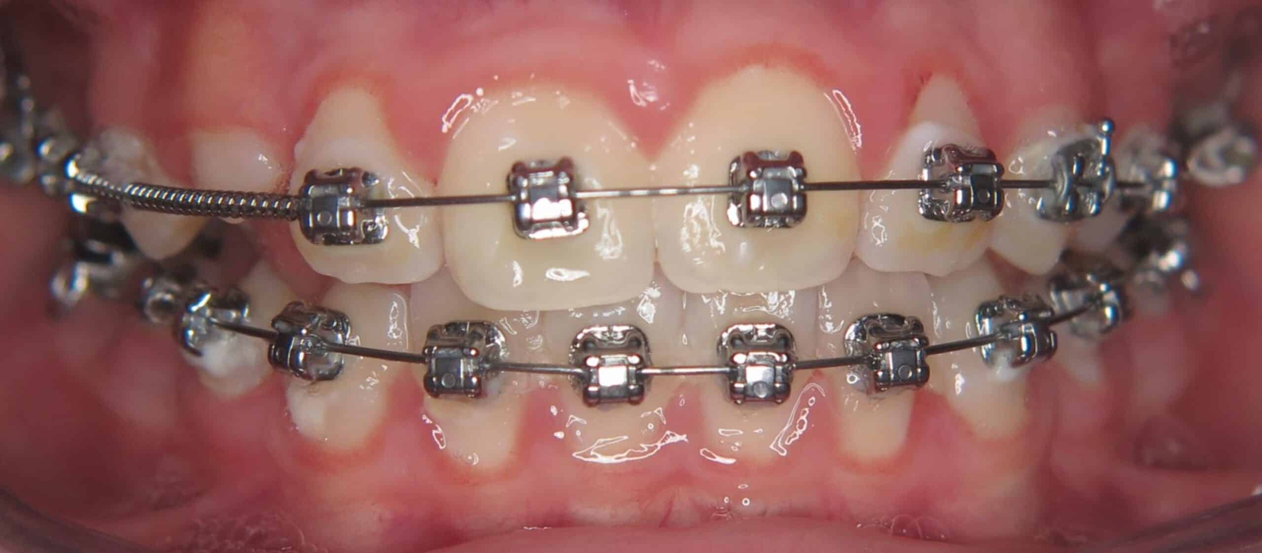 Damon-Brackets im Mund