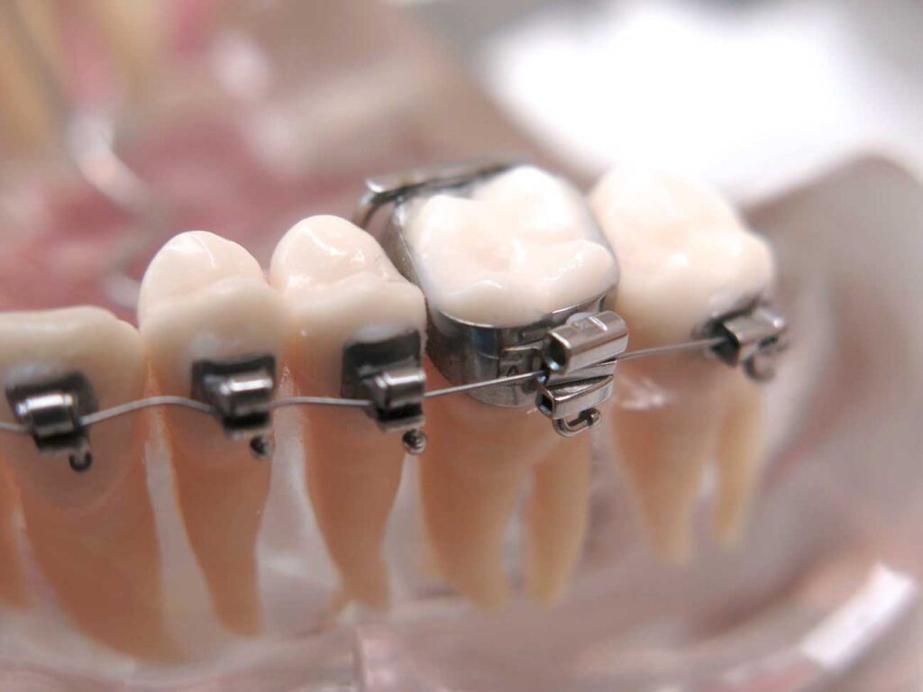 Z&auml;hne mit Brackets und einem Zahnring (Band). B&auml;nder werden heute nur noch wenig benutzt