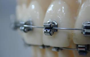 Selbstligierende Brackets