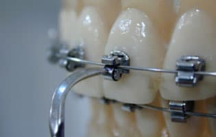Selbstligierende Brackets