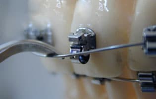 Selbstligierende Brackets