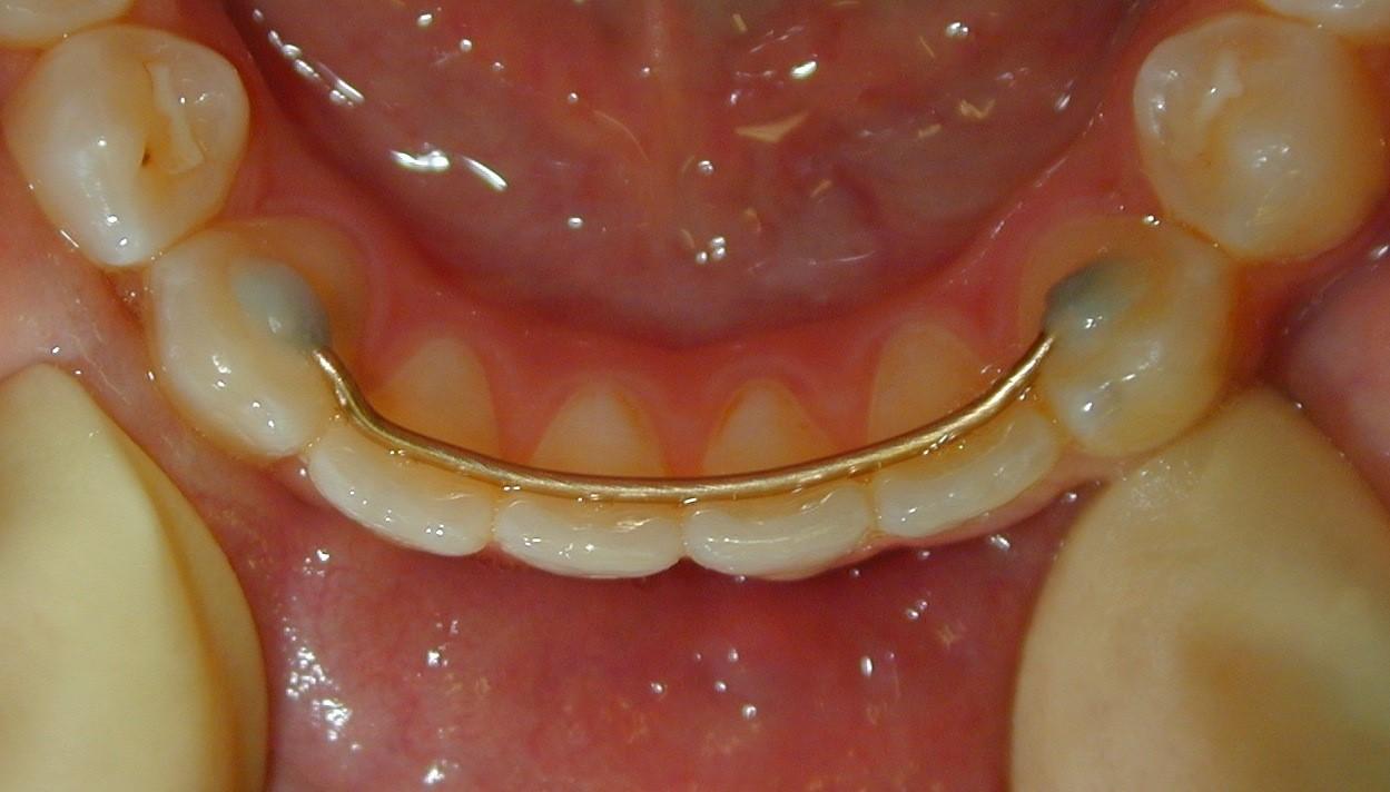 RetainerKieferorthopäde Dr. Madsen