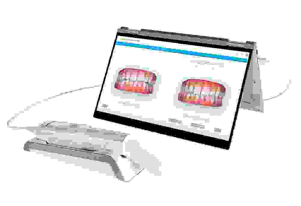 Itero®-Scanner mit Invisalign-Behandlungssimulation