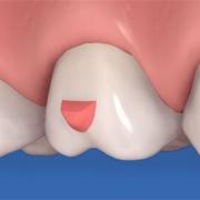 Invisalign-Attachment zur Verlängerung eines Zahns Invisalign-Attachment zur Verlängerung eines Zahns