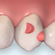 Invisalign-Attachment für Wurzelkontrolle Invisalign-Attachment für Wurzelkontrolle