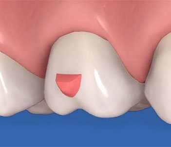 Invisalign-Attachment zur Verlängerung eines Zahns