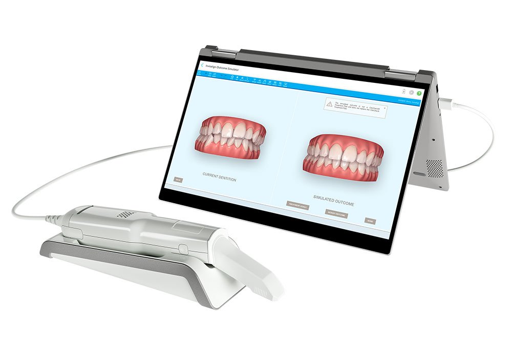 Itero®-Scanner mit Invisalign-Behandlungssimulation