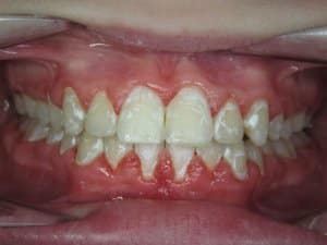 Ausgeprägte Demineralisation bei einem Patienten mit schlechter Mundhygiene