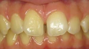 Diastema mediale: ein rein ästhetisches Problem