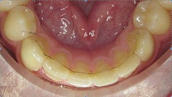 festsitzender Retainer, intraorale Aufnahme, Haltephase