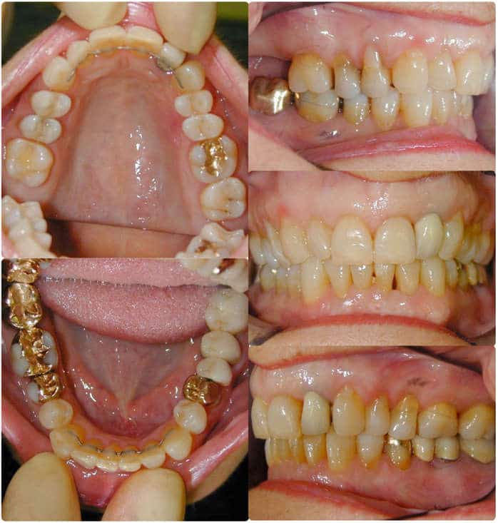 Zahnfotos, frontal, seitlich und intraoral, Abschluss der Behandlung mit festem Retainer