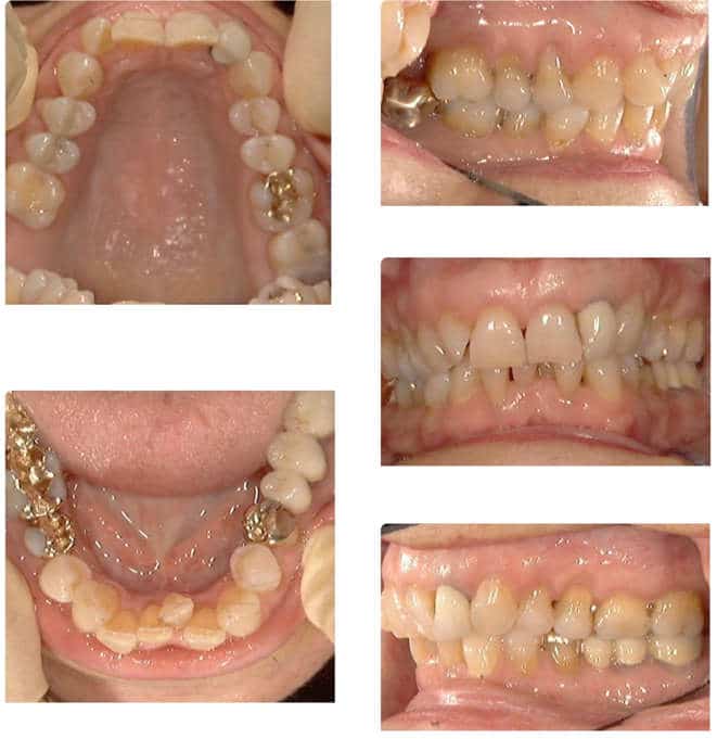 Zahnfotos, frontal, seitlich, intraoral, Beginn der kieferorthopädischen Behandlung