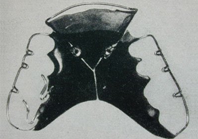 Y-Plate with screws for the upper jaw