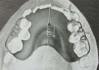 Upper jaw plate with closed screw