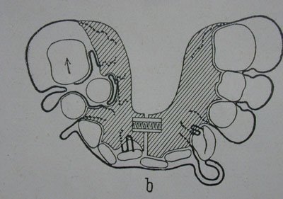 Diagram of a particularly nice, if somewhat Baroquely-ornate lower jaw plate – how are children supposed to deal with their everyday life with this thing in their mouths?