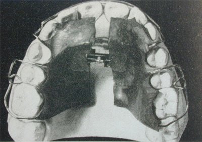 Upper jaw plate with open screw