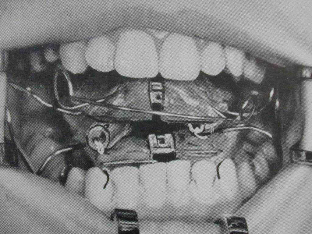Herausnehmbare Zahnspangen im Mund