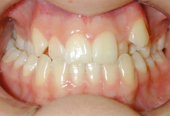 Feste Zahnspange: Istzustand der Zahnreihen vorher