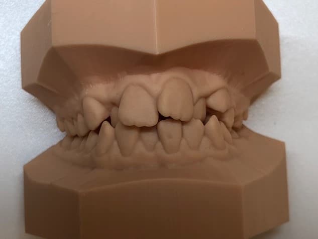 Kiefermodell nach Behandlung mit herausnehmbarer Zahnspange nachher