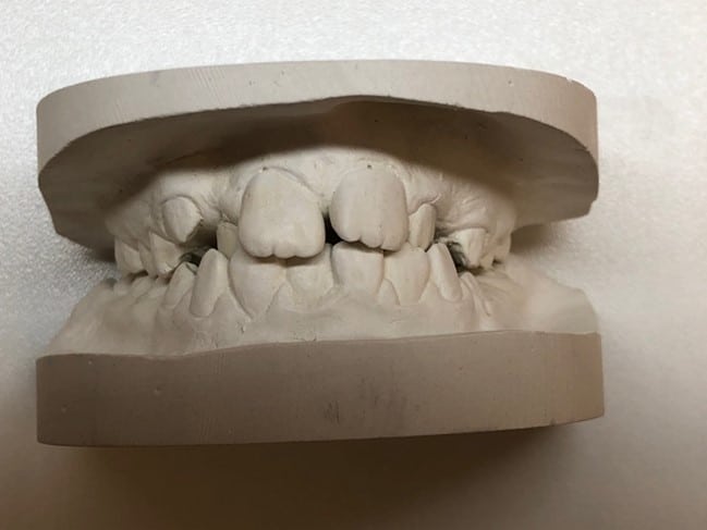 Kiefermodell vor der Behandlung mit herausnehmbarer Zahnspange