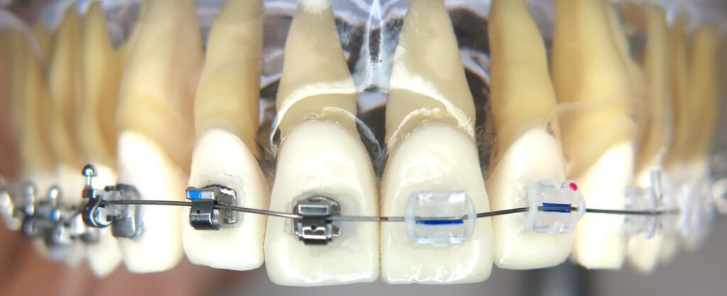 Festsitzende Zahnspange mit selbstligierenden Stahlbrackets (Speed) links, Keramikbrackets rechts: besseres Aussehen ist offensichtlich, aber manche Zahnbewegungen gelingen mit Stahlbrackets besser