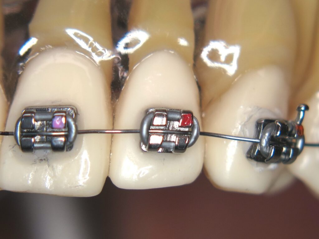 ...oder mit klassischen Brackets mit vier Flügeln und elastischen Ligaturen – der Größenunterschied fällt sofort auf