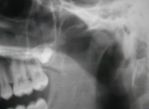 kieferorthopaediebyd35mnny9wkbiam Röntgenbild des Kiefergelenks (Ausschnitt einer Panoramaschichtaufnahme)