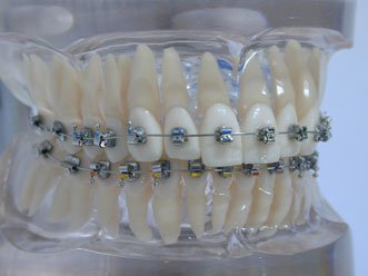 Moderne Bracket-Zahnspange