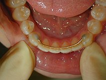 Fixed retainer with two adhesions to the canine teeth