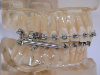 SUS with brackets and bands