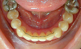 Fixed retainer with six adhesions to all anterior teeth